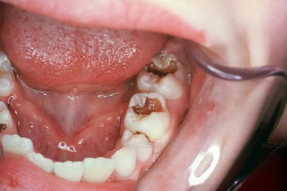 What Is The Medical Term For Dental Caries